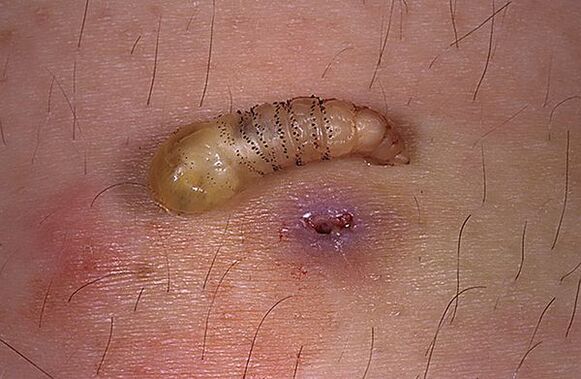 Menschliche subkutane parasitäre Larve
